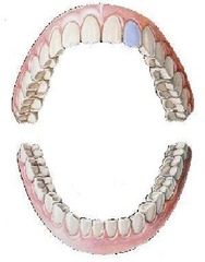 <p>maxillary left lateral incisor</p>