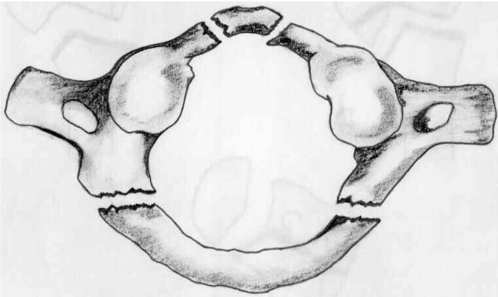 <ul><li><p>Compressive downward force transmitted evenly through occipital condyles to superior articular surfaces of lateral masses of C1</p></li><li><p>This displaces masses laterally and causes fractures of anterior and posterior arches</p></li><li><p>Possible disruption of transverse ligament (displacement of lateral masses is >6.9mm) (consider instability)</p></li></ul><p>→ If less than 6.9mm, transverse ligament still intact and neurologic injury unlikely</p><p></p>