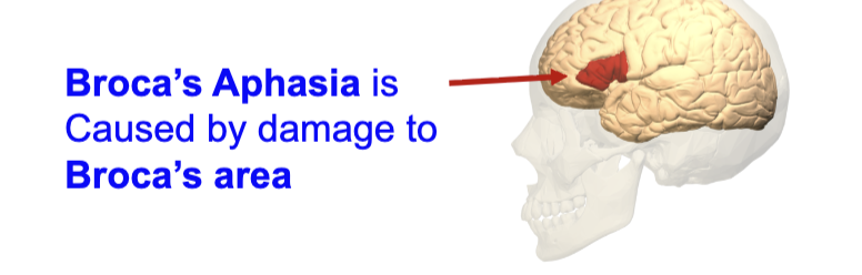 <ul><li><p>Provides first solid evidence of brain modularity </p></li><li><p>First described in a patient named Lebrorgne </p></li><li><p>Leborgne was unable to speak after damage to his left frontal lobe, but had normal chewing and language comprehension </p></li><li><p>Similar patients were subsequently seen with damage in the same area</p></li><li><p>Before brain scans, unusual deficits described patients required subsequent investigation through autopsy – supported views of “localisationists.” </p></li></ul><p></p>