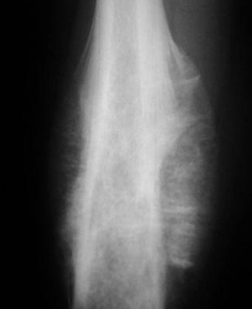 <p>__ radiographic appearance seen in Ewing sarcoma (“like osteosarcoma”)</p>