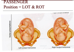 <p>fetal presenting part either to the right or left side of the pelvis</p>
