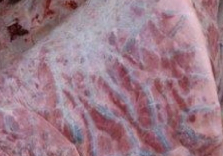 <p><u>Sources:</u> Change from poor quality → Lush and rapidly growing forage within 5 - 10d</p><ol><li><p>Lush pasture</p></li><li><p>Lucerne</p></li><li><p>Kale</p></li><li><p>Turnips</p></li><li><p>4-ipomeanol in mouldy sweet potatoes causes the same syndrome</p></li></ol><p><u>Seasonality:</u> Autumn (foggy) and aftergrowth from recently cut silage</p><p><u>MoA:</u> Pneumotoxic metabolite → <strong>Acute Bovine Pulmonary Oedema and Emphysema</strong></p><ol><li><p>L-tryptophan → Indole-acetic acid → 3-methylindole by rumen microbes (<em>Lactobacillus</em>)</p><ul><li><p>Peak 4 - 5d and drops off after 6 - 7d</p></li></ul></li><li><p>3-methylindole in blood → Lungs</p></li><li><p>Activation of pneumotoxic metabolite (3-methyleneindolenine) by type II pneumocytes (Clara cells) → Cellular damage and necrosis of type I pneumocytes (required for gas exchange)</p></li><li><p>Proliferation of type II pneumocytes</p></li><li><p>Decreased gas exchange surfaces and thickened septa with interstitial oedema</p></li></ol><p><u>Clinical Signs:</u> 4 - 5d after ingestion</p><ol><li><p>Sudden tachypnoea and expiratory dyspnoea</p></li><li><p>Reluctance to move and weakness</p></li><li><p>Auscultation = Respiratory grunt and occasional soft crackles</p></li><li><p>Normothermic</p></li><li><p>Orthopnoea = Head extended, nostrils dilated, open-mouth breathing and elbows abducted</p></li><li><p>Subcutaneous emphysema may occur with rupture of bulla</p></li><li><p>Acute deaths or within 1-2 days</p><ul><li><p>30 - 50% morbidity</p></li><li><p>30% mortality</p></li></ul></li></ol><p><u>Diagnosis:</u> History of exposure to lush feed or diet change with sudden respiratory signs →</p><ol><li><p>Measure L-tryptophan in feed</p></li><li><p>PM examination = Heavy wet lungs with foam in trachea and interlobular oedema/emphysema</p></li><li><p>Histology of lungs = Interstitial pneumonia</p></li></ol><p><u>Treatment:</u></p><ol><li><p>Remove from feed if <5d (care to avoid exertion → sudden death)</p></li><li><p>Frusemide to enhance water elimination</p></li><li><p>NSAIDs</p></li></ol><p><u>Prevention:</u></p><ol><li><p>Provide supplemental feed to prevent large intake of pasture</p></li><li><p>Graze pastures with cattle <15 months (less susceptible)</p></li><li><p>Monensin/ionophores 200mg/cow/d begun a few days prior to movement onto lush pasture → Reduced production of 3-methyl-indole in rumen</p></li></ol><p></p>