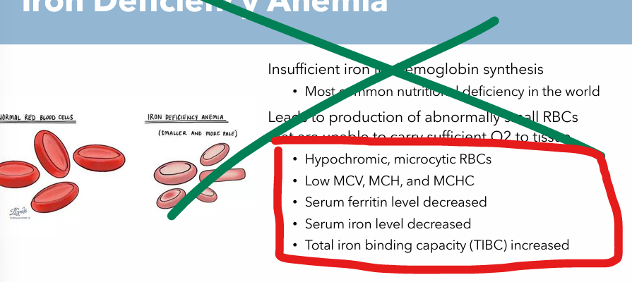 <ul><li><p>Hypochromic, Microcytic RBCs</p></li><li><p>Low MCV, MCH, and MCHC</p></li><li><p>Serum ferritin level decreased</p></li><li><p>Serum Iron level decreased</p></li><li><p>Total Iron binding capacity (TIBC) increased</p></li></ul><p></p>