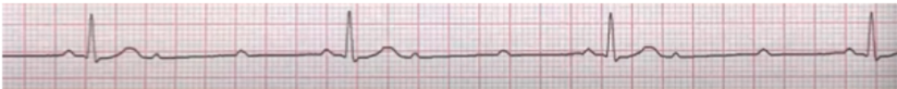 <ul><li><p><span style="background-color: transparent;">Mobitz 2</span></p></li><li><p><span style="background-color: transparent;">Regular</span></p></li><li><p><span style="background-color: transparent;">More Ps than QRSs</span></p></li><li><p><span style="background-color: transparent;">Consistent PR interval</span></p></li><li><p><span style="background-color: transparent;">Typically very bradycardic&nbsp;</span></p></li><li><p><span style="background-color: transparent;">Heart rate: 38bpm</span></p></li><li><p><span style="background-color: transparent;">Rhythm: regular</span></p></li><li><p><span style="background-color: transparent;">P waves: present, more than QRS</span></p></li><li><p><span style="background-color: transparent;">PR interval: consistent</span></p></li><li><p><span style="background-color: transparent;">QRS complex: narrow</span></p></li></ul><p></p>