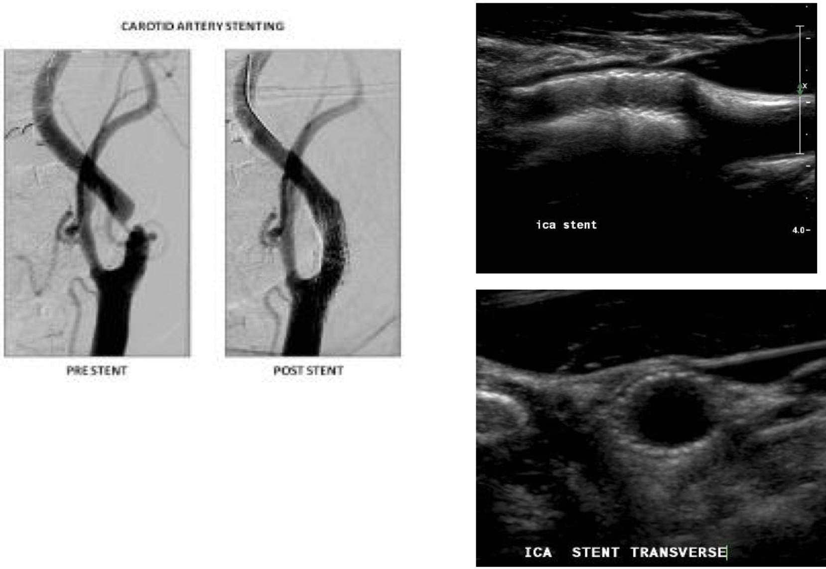 <p>Tube made of metal that is inserted into a vessel to keep it open. Stents are used during an angioplasty. Non invasive & performed in femoral or radial artery. Self expanding or balloon deployed.</p>