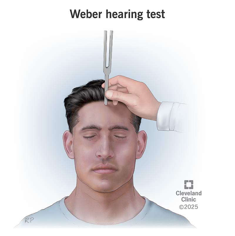 <p>• Tuning fork placed at midline of skull</p><p>• Normal: sound heard equally in both ears</p>