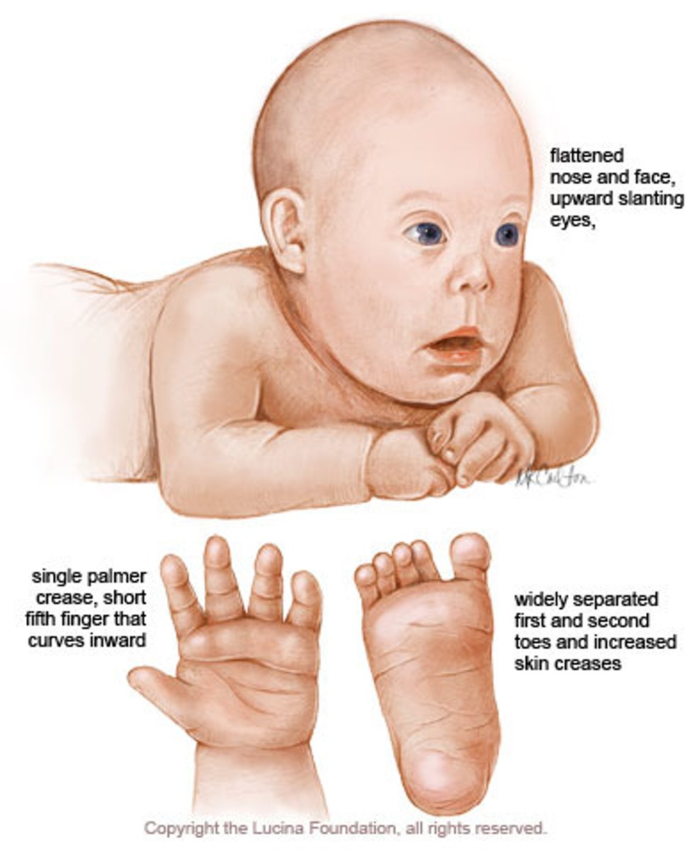 <p>- the most common chromosomal abnormality</p><p>- characterized by moderate-to-severe intellectual disability</p><p>- also called trisomy-21</p>