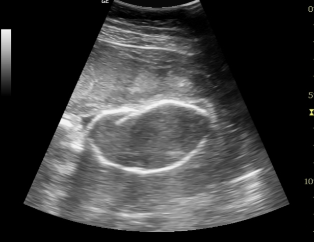 <ul><li><p>may see skin, scalp, + generalized edema</p></li><li><p>spalding sign** (cranial bone overlapping)</p></li><li><p>ascites</p></li><li><p>oligohydramnios</p></li><li><p>abnormal position / spine curvature</p></li></ul><p></p>