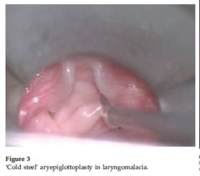 <p><span>inspiratory stridor within first 2/52 of life exacerbated by feeding, agitation, supine, airway obstruction caused by collapse of supraglottic structures on inspiration -> Mx = aryepiglottoplasty</span></p>