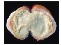 <p>What type of necrosis is this?</p>
