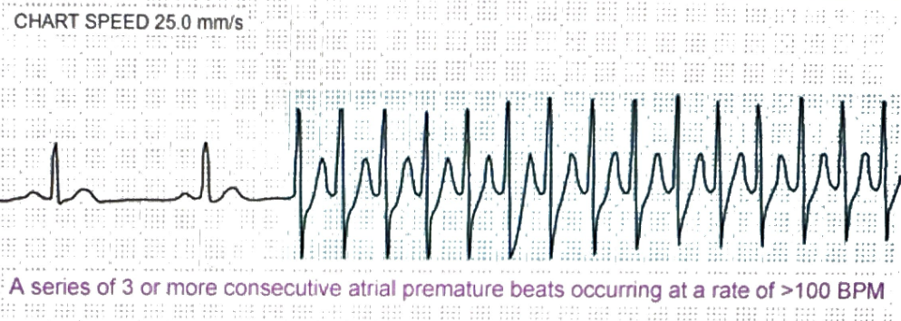 <p>Usually paroxysmal, meaning it starts and ends abruptly</p>