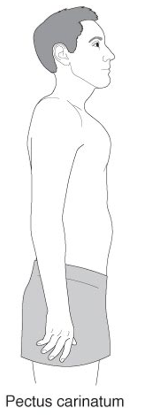 <p>pectus carinatum </p>