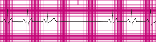 <p>Which rhythm is this?</p>