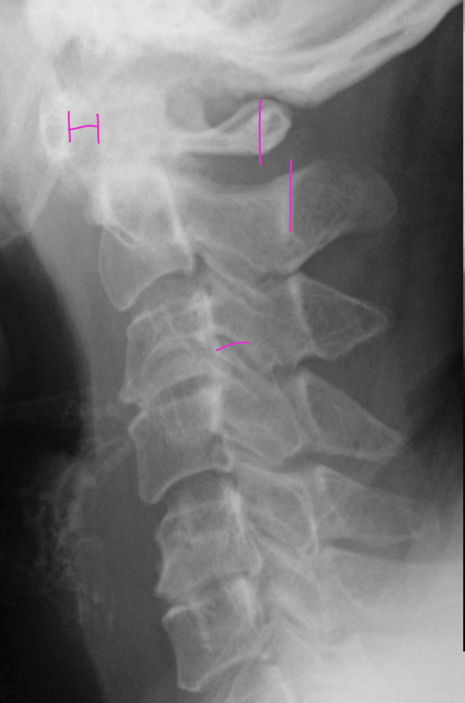 <p>What finding is on this film besides a widened ADI</p>