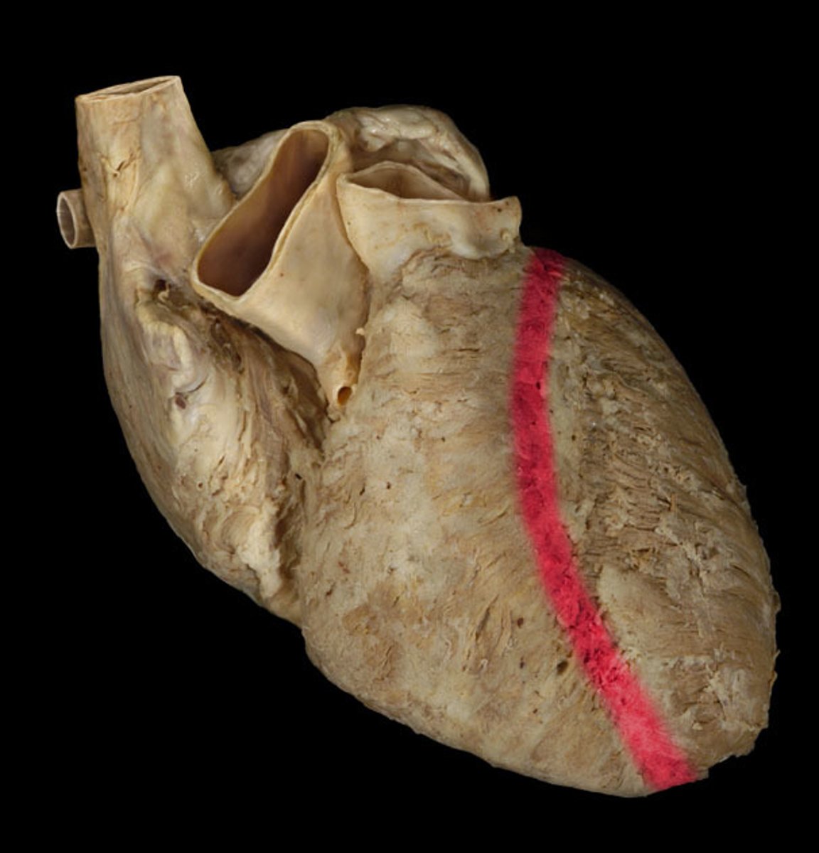 <p>Groove on the anterior heart surface separating the right and left ventricles.</p>