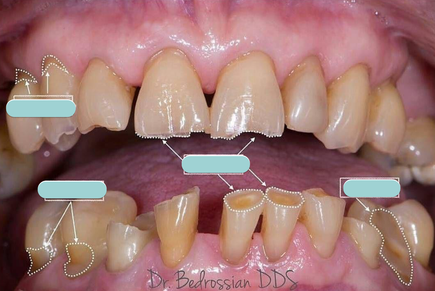 <p>abfraction vs abrasion</p>