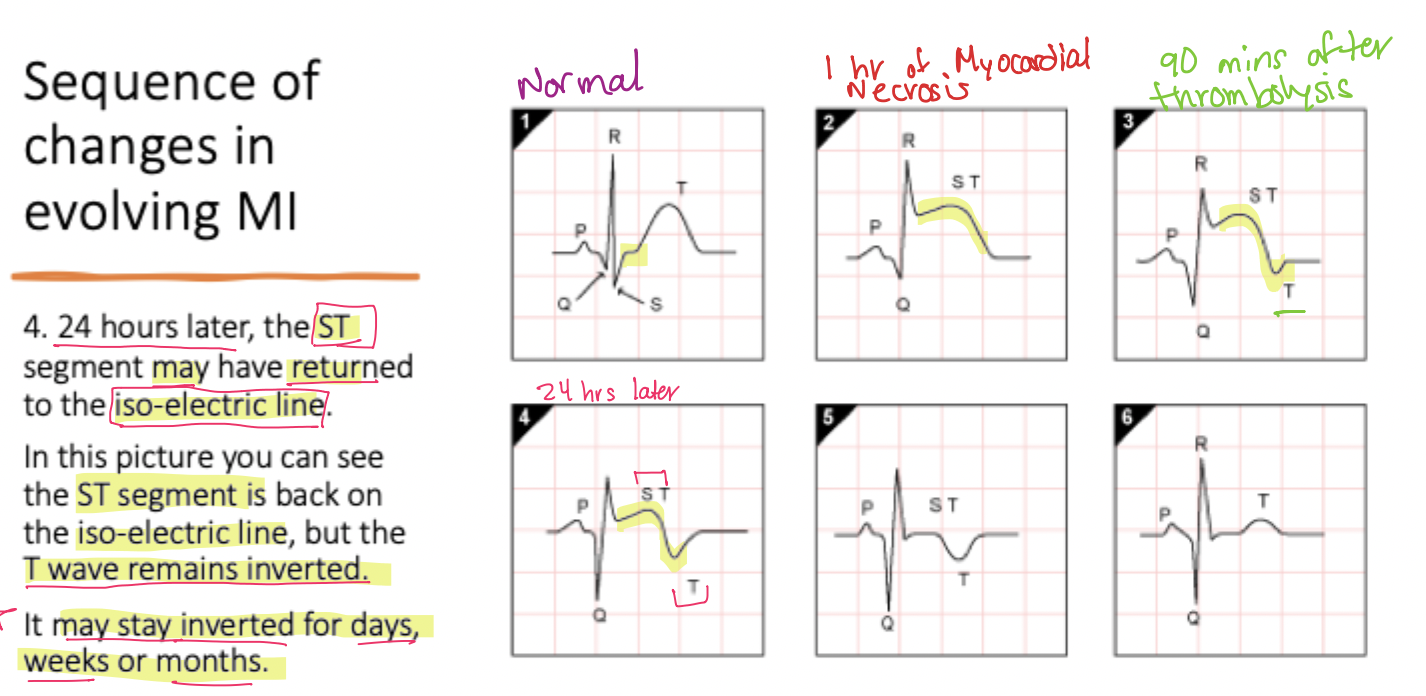 <p>The <strong>ST segment </strong>returns to the <strong>isoelectric line,</strong> while the <strong>T-wave remains inverted</strong></p>