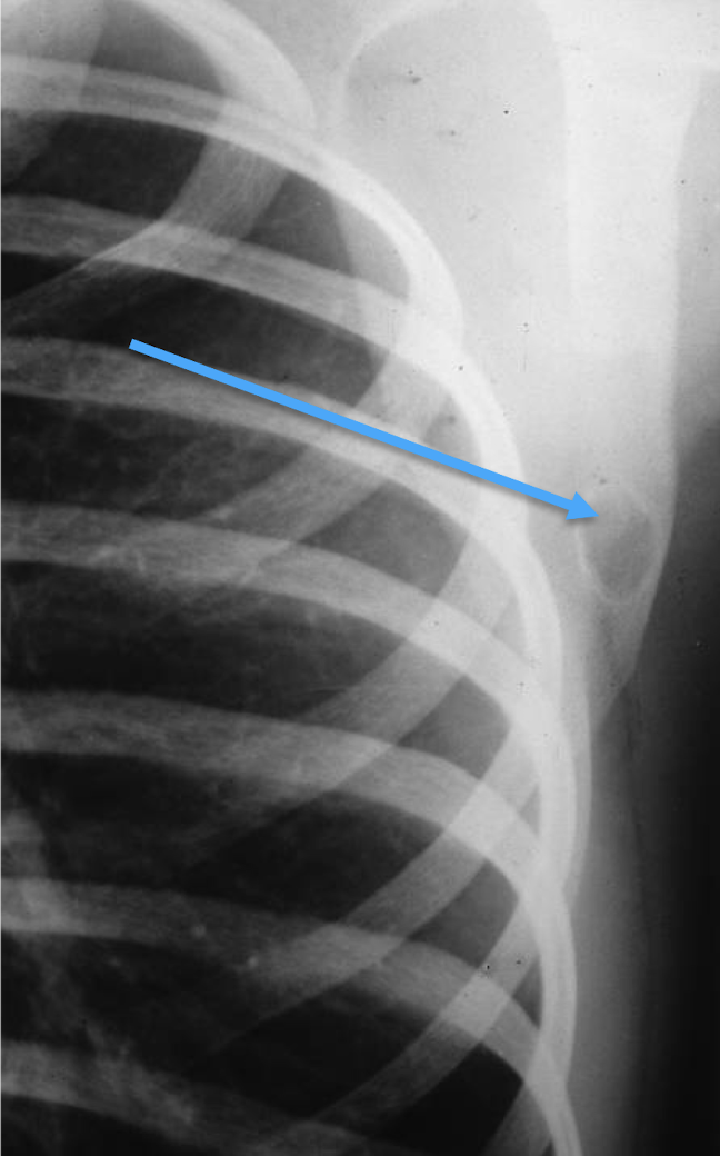 <p>What bone tumour is this, what bone is it in and what can be seen?</p>