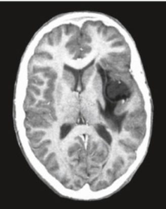 <p><span>a measure of X-ray absorption at several positions around the head; maps tissue density</span></p>
