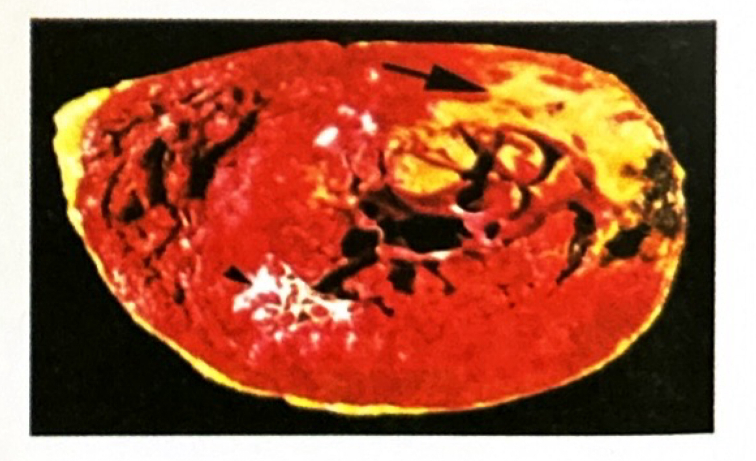 <p>Gross Image Clue: A cardiac ventricular slice from a patient who died $$3\,\text{days}$$ after severe substernal chest pain shows a central pale yellow-tan soft region with a hyperemic red border. What is the diagnosis and key gross features according to Ramdas Nayak?</p>
