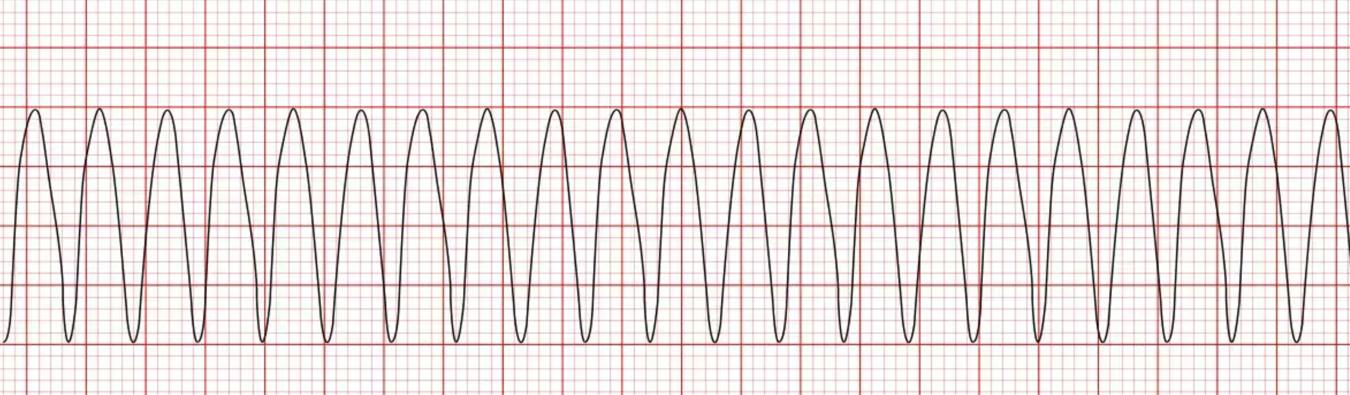 <p>the image shown depicts what cardiac arrhythmia?</p>