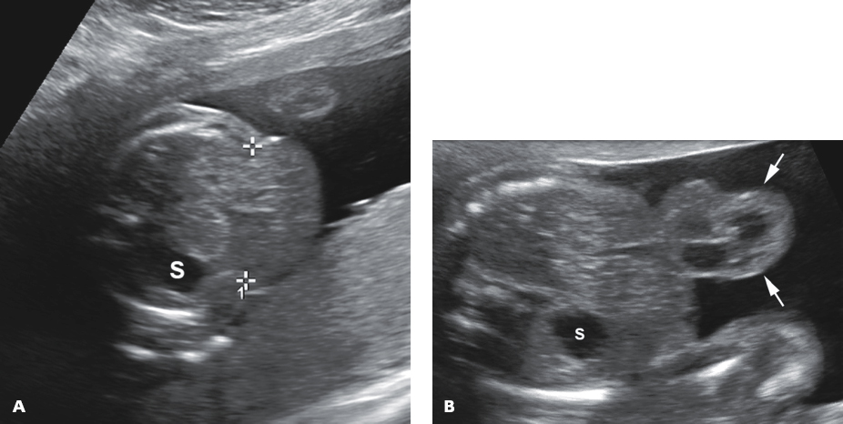 <p> omphalocele, along with ectopic cordis, cleft sternum, anterior diaphragmatic defect, and pericardial defects</p>