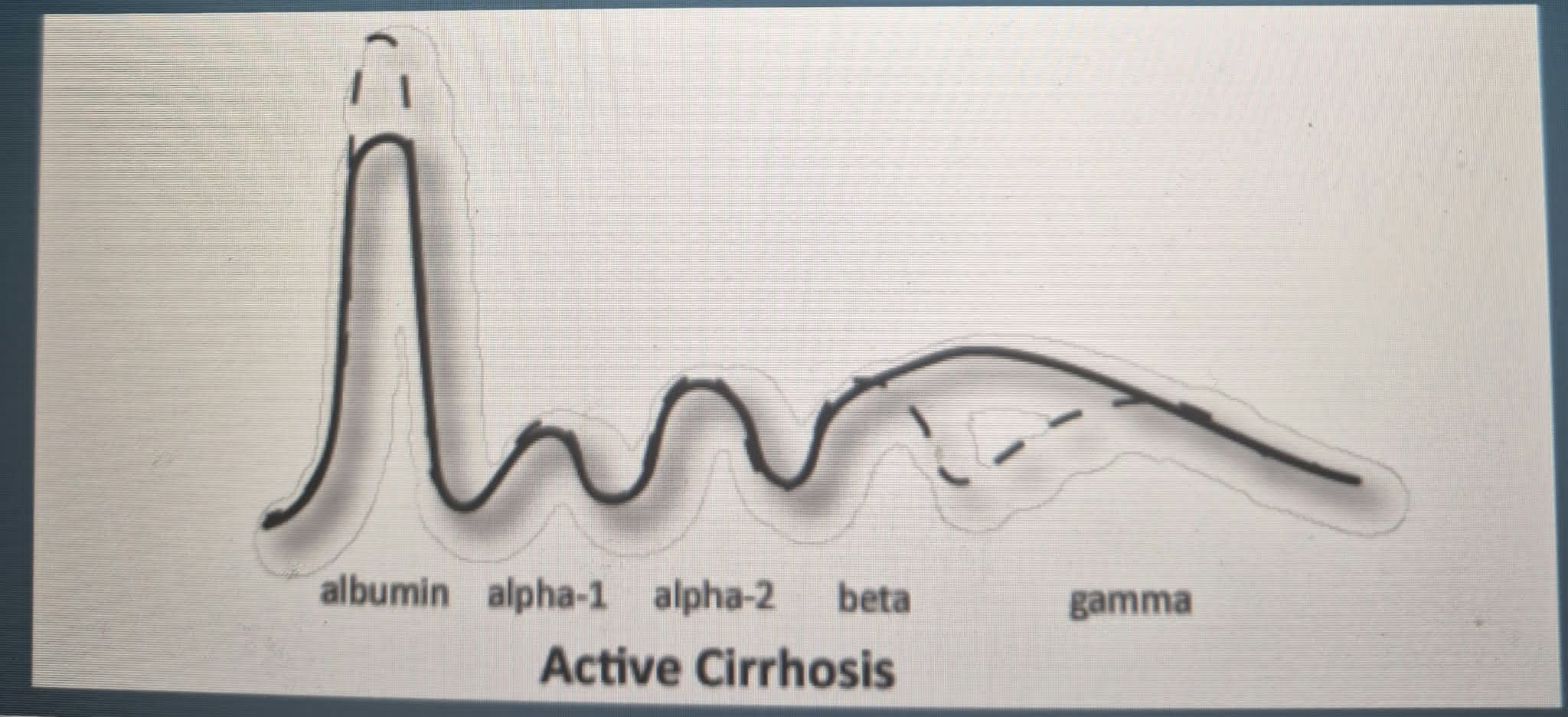 <p>• The electrophoretic <strong><em><u>pattern of serum proteins</u></em></strong> in liver disease shows the decrease in serum</p><p>albumin concentration and the increase in <strong><em><u>gamma globulin.</u></em></strong></p><p>• In the pattern of cirrhosis of the liver, there are some<strong><em><u> fast-moving gamma globulins</u></em></strong> that prevent</p><p>resolution of the (____) and the (______________).</p><p>• This is known as the (____________________).</p><p></p>