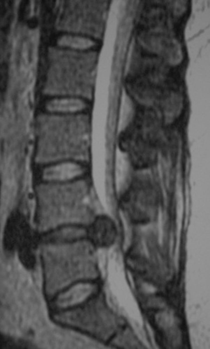 <p>herniation extends past level of the disc (cranial & caudal migration)</p>