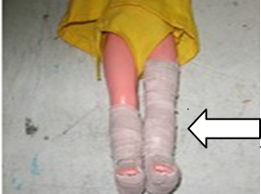 <p>tibia-fibula<span> </span>affections<span> </span>with<span> open</span></p><p><span style="font-family: Calibri, sans-serif;">wound, swelling and infection</span></p>