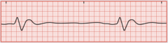 <p>Results when all the pacemakers of the heart have failed. The ventricular rate is less than 20/min. The EKG shows a very wide, bizarre QRS complex with no P or T wave. Will more than likely result in a cardiac arrest</p>