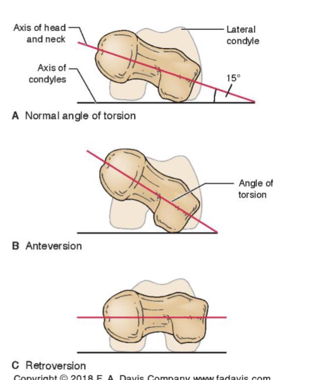 <p><strong>Normal: </strong></p><ul><li><p>femoral condyles = horizontal  &amp; head of femur is <strong>NOT </strong>in same plane as condyles </p></li></ul><p></p><p><strong>Anteversion: </strong></p><ul><li><p>both femur + acetabulum have anteversion</p></li><li><p><strong>Increased</strong> angle (off table + angle twd front) </p></li></ul><p></p><p><strong>Normal: </strong></p><ul><li><p>head + neck in plane w/ femoral condules</p></li><li><p><strong> Reduced </strong>angle (twd table) </p></li></ul><p></p>