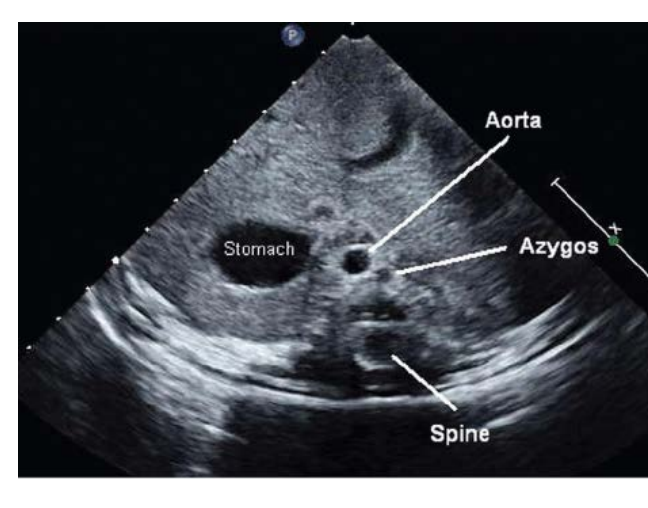 <p>Double vessel sign with Aorta and “vein stacked” • </p><p>Interrupted IVC with Azygous continuation •</p><p> Liver is midline •</p><p> Will have two left atrium • </p><p>Bilateral bilobed lung •</p><p> Variable stomach position • </p><p>Multiple spleen</p>