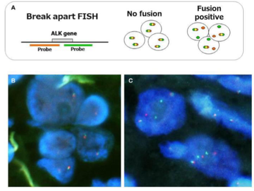 <p>• Fusion probe or break apart probe to detect these</p><p>• Two probes around the ALK gene</p><p>• Both fluoresce different colours</p><p>• When a fusion occurs they “break apart” and are separated</p><p>• If normal then they are overlapping</p><p>• Doesn’t tell you the partner gene but tells you there is a translocation present</p>