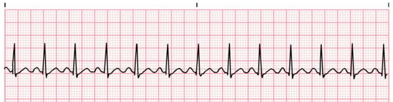 <p>Sinus tachycardia</p><p>If symptomatic, treat cause.</p><p>Stable pts:</p><p>1) Vagal maneuver to drop HR</p><p>2) Beta blockers (metoprolol)</p><p>Unstable pts: cardioversion</p>