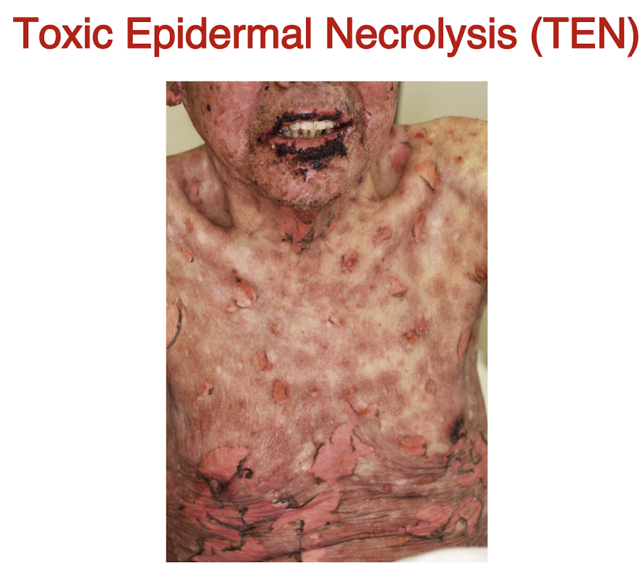<p>A severe life-threatening skin disorder characterized by widespread epidermal detachment.</p>