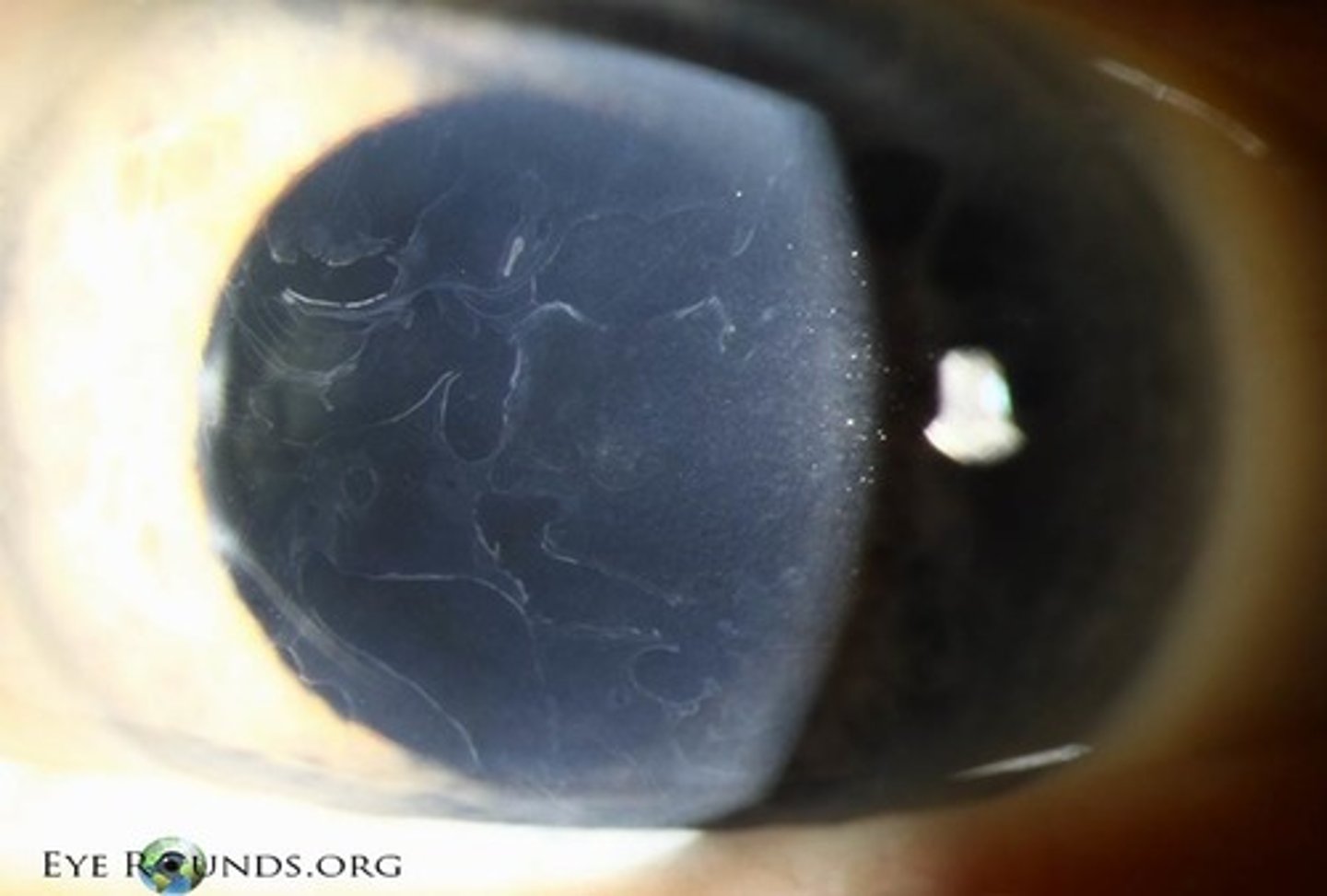 <p>raised dots, maps and fingerprints and results in negative staining. The elevations of the ocular surface, result in an immediate tear film break-up over the corresponding area. Patients are usually asymptomatic unless the dots, maps and fingerprints erupt, at which time they will stain positively and become symptomatic</p>