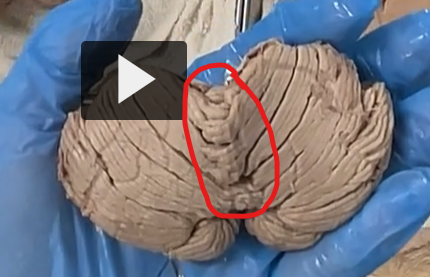 <p>The <strong>left </strong>and <strong>right hemisphers</strong> are separated by a midline structure called the <strong>vermis</strong>. </p>