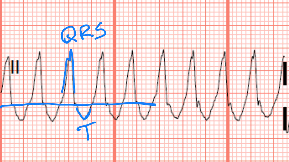 <p>Ventricular origin or delayed intraventricular conduction such as bundle branch block.</p>