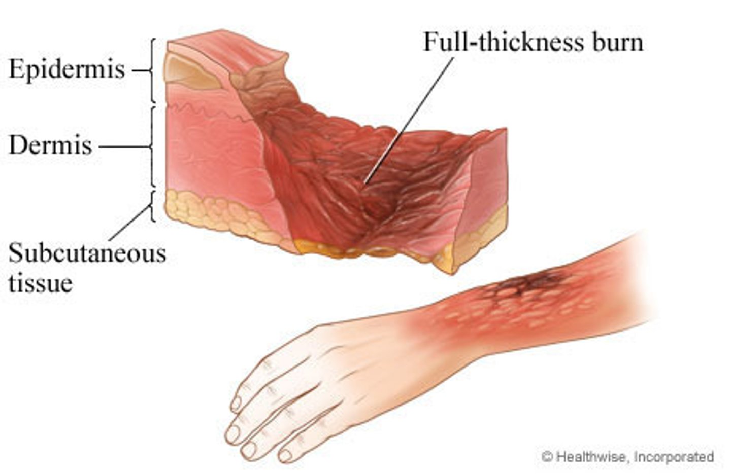 <p>thermal damage to all three layers of the skin, also cooks blood vessels, so it appears to be dry and leathery- color depends on agent</p>