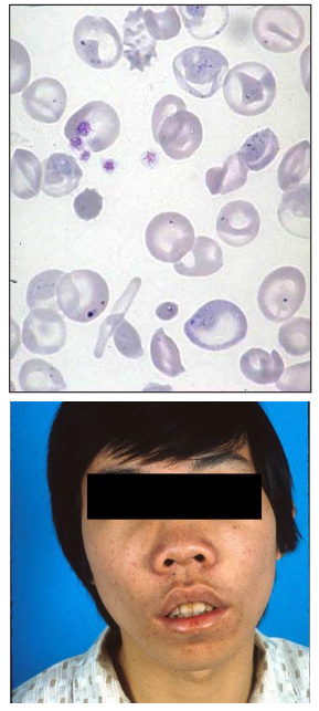 <p>- Dx: 3-6 months (when HbF no longer made and unable to make HbA (no beta chains)</p><p>- Symptomatic severe anaemia (Hb, 50g/L)</p><p>- extramedullary erythropoiesis: spleen</p><p>- Bone marrow expansion</p><p>TRANSFUSION DEPENDENT (lifelong):</p><p>- Iron overload</p><p>- Iron chelation therapy</p><p>- Long survivors; secondary problems (e.g bone thinning - osteopenia)</p><p>.</p><p>- Bone marrow transplantation</p>