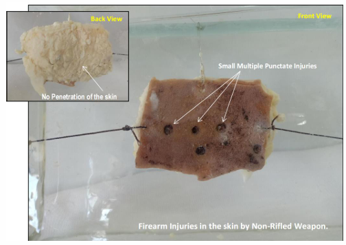 <p>Questions</p><ol><li><p>What is the specimen being examined?</p></li><li><p>What are the specific shape, count, diameter, and penetration characteristics of the injuries?</p></li><li><p>What characteristic of the wound edges is described?</p></li><li><p>How is the antemortem nature of this injury determined?</p></li><li><p>What type of causative instrument produced this injury?</p></li><li><p>How is the time of death estimated?</p></li><li><p>What is the possible cause of death?</p></li><li><p>What is the final diagnosis?</p></li></ol><div data-type="horizontalRule"><hr></div><p></p><p></p>