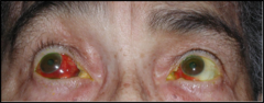 <p>can be due to INR being off with warfarin use (coagulopathy)</p>