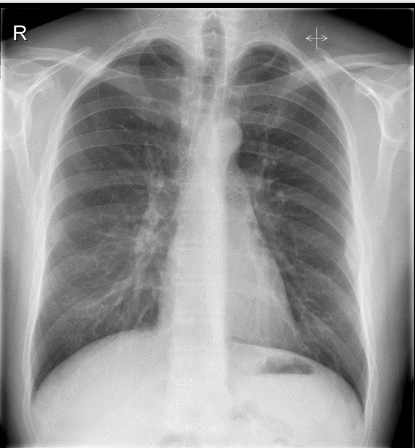 <p><span>Male. 32 years. Complains of severe left sided chest pain.</span></p>