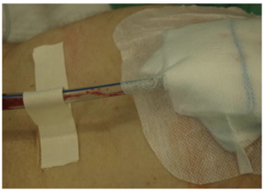 <p>how should the nurse manage a patient with a chest tube?</p>