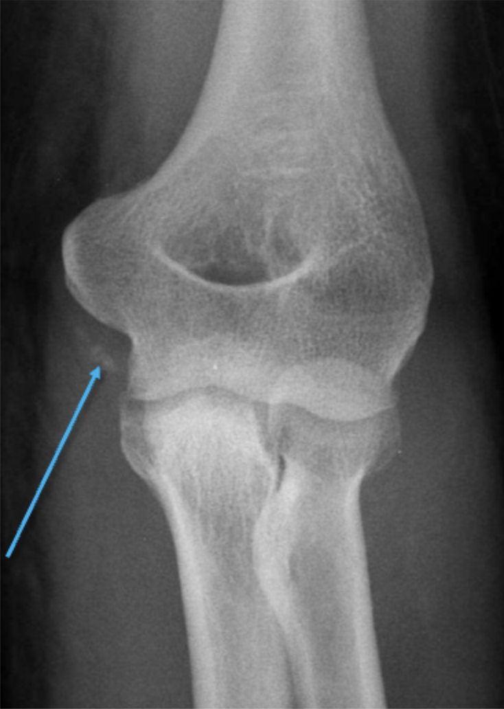 <p>What can be observed in this image and what structure is being affected? What is this indicative of?</p>