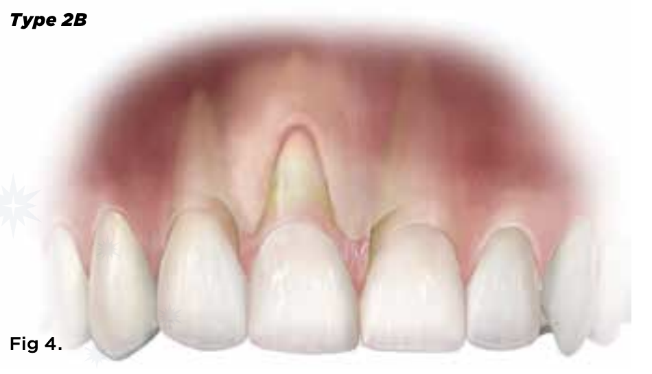 <p>What support discrepancy is magnified by 2b tissue in distal extension RPDs?</p>