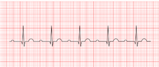 <p>is a regular rhythm with the PR interval constantly prolonged. All other aspects of</p><p>the EKG may appear normal.</p>