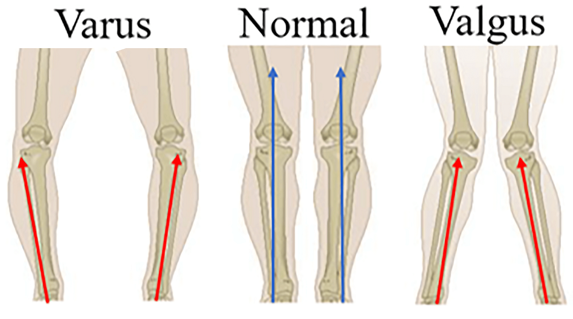 <p>Description: The medial femoral condyle is angled and extends farther out than the lateral condyle, producing a typical genu valgus posture at the knee (knock-knee). Genu varum = bowleg.</p>