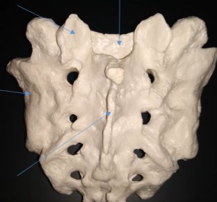 <p>What is the arrow in the lower/middle pointing at of the sacrum?</p>