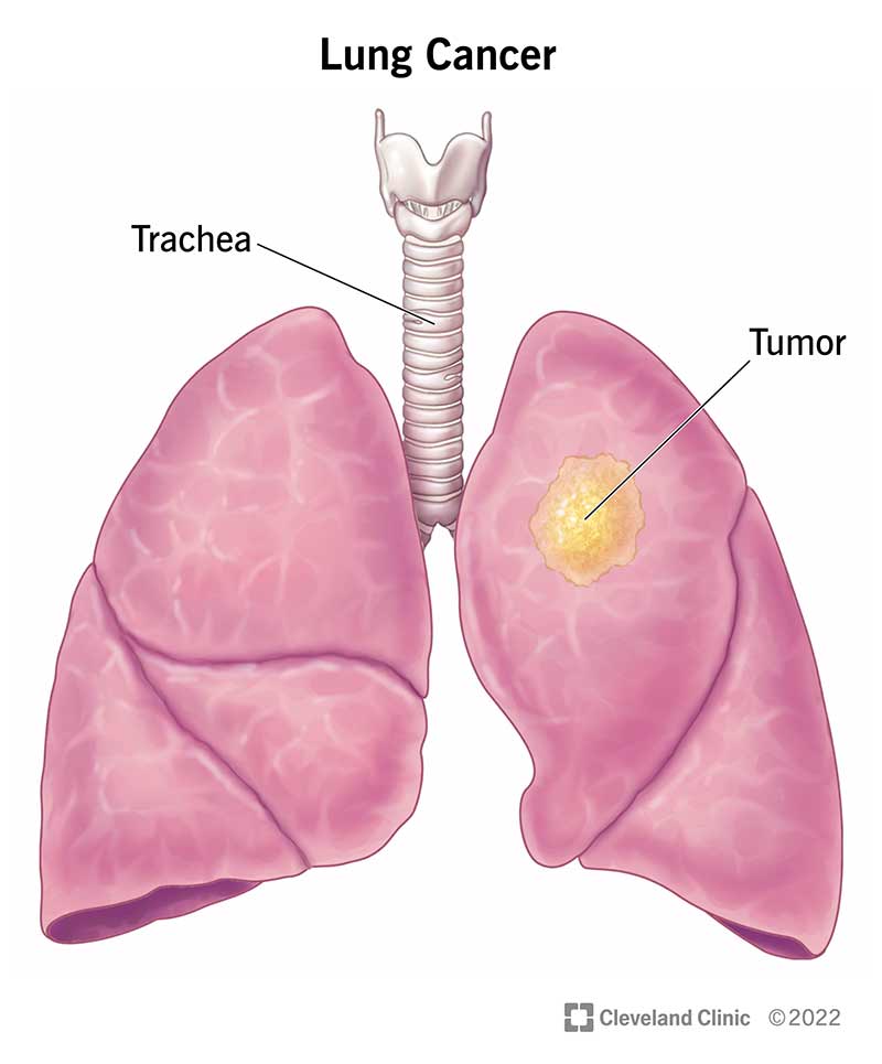 <p>Lung cancer is when bad cells grow in the lungs and make breathing difficult.</p><p>Example: A person cannot breathe easily.</p>